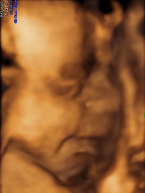 Ultraschall – Baby in 26 Schwangerschaftswoche
